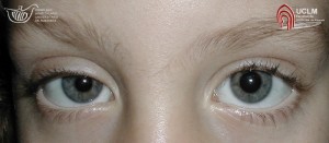 Pupille anisocoriche